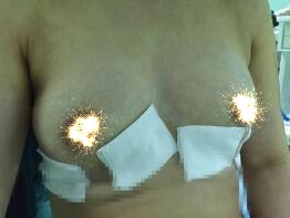 慈溪悅爾整形醫(yī)院趙天宇做自體脂肪隆胸怎么樣？附自體脂肪隆胸案例