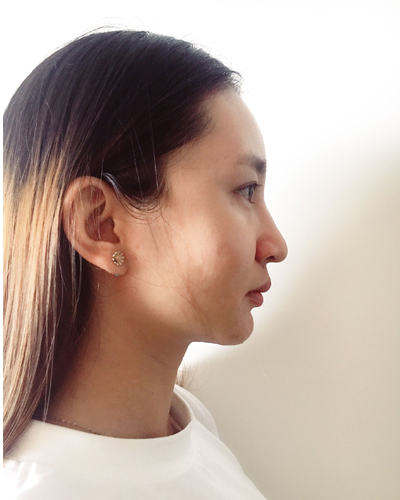 武漢維納斯整形醫(yī)院趙瑾醫(yī)生做玻尿酸墊下巴怎么樣？附玻尿酸墊下巴案例