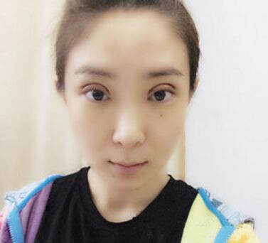 武漢中翰整形外科醫(yī)院陳志鵬醫(yī)生做雙眼皮修復效果怎么樣？附雙眼皮修復案例