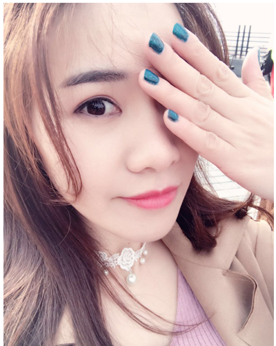 營(yíng)口臻美醫(yī)療整形醫(yī)生閆迎軍做雙眼皮效果怎么樣？附雙眼皮案例對(duì)比圖