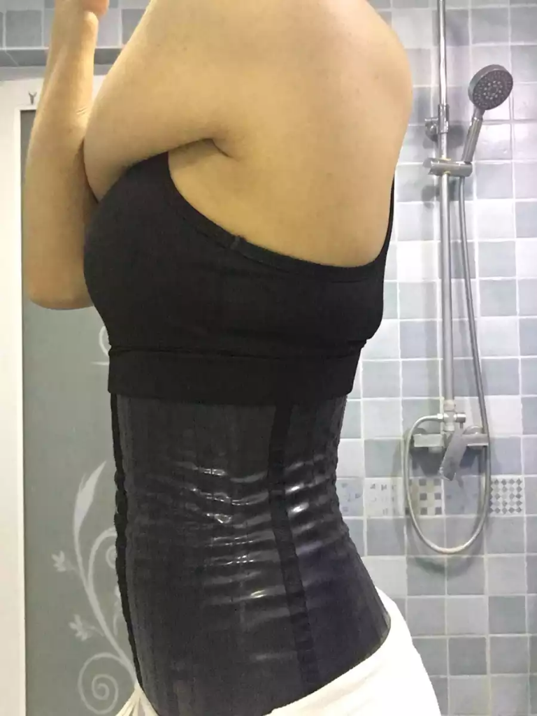 沈陽天使醫(yī)療整形醫(yī)生黃展翼做水動力腰腹吸脂技術(shù)怎么樣？附水動力腰腹吸脂案例