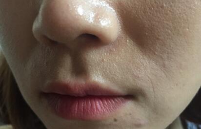 信陽(yáng)東方藝美容醫(yī)院劉力萌做玻尿酸去法令紋效果怎么樣？附案例效果對(duì)比圖