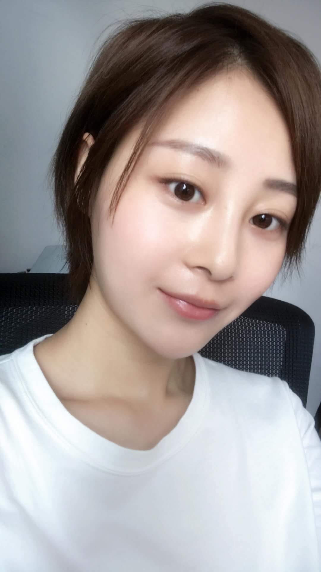 天津歐華威莎整形醫(yī)生姚玲做面部埋線提升效果怎么樣？附埋線提升案例