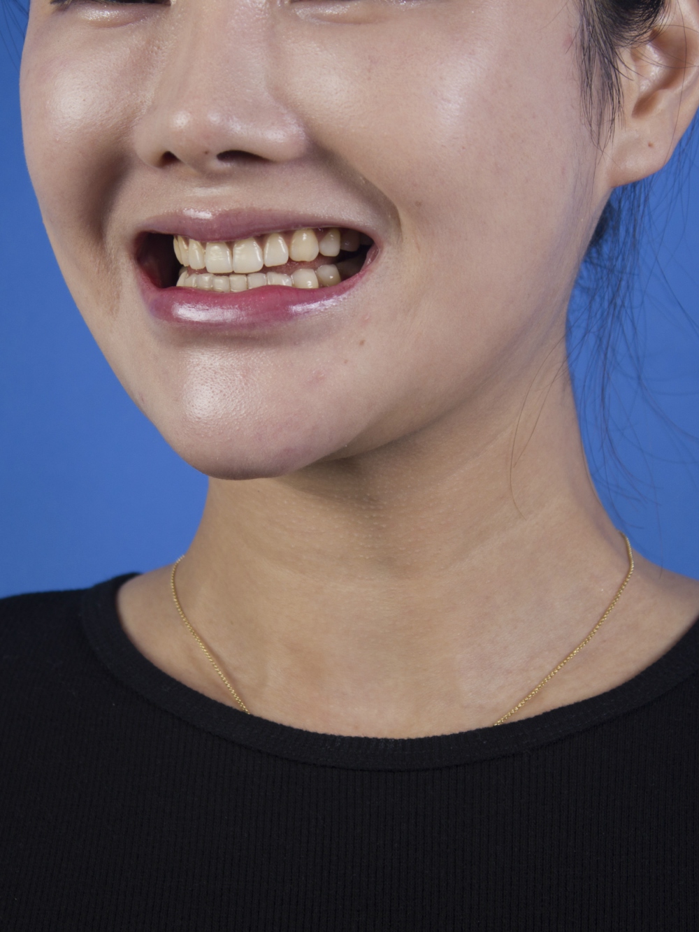 廣州柏德口腔蘭海龍醫(yī)生做瓷貼面效果怎么樣？廣州柏德口腔瓷貼面案例分享