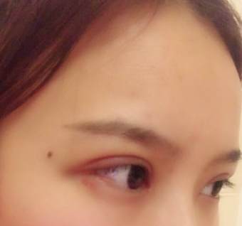 長春麥西美嘉整形醫(yī)生王圣博做雙眼皮手術(shù)效果怎么樣？附雙眼皮案例