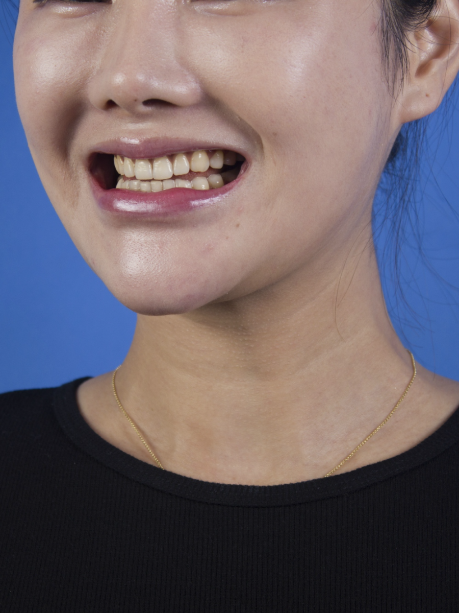 廣州柏德口腔蘭海龍醫(yī)生做瓷貼面效果怎么樣？廣州柏德口腔瓷貼面案例分享