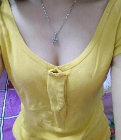 慈溪悅爾整形醫(yī)院趙天宇做自體脂肪隆胸怎么樣？附自體脂肪隆胸案例