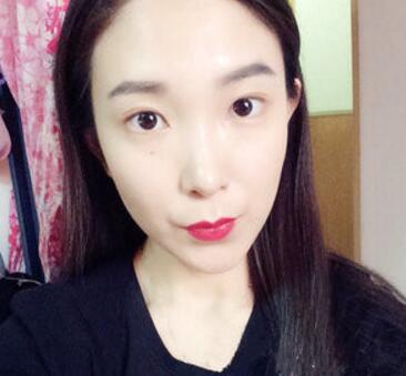 武漢中翰整形外科醫(yī)院陳志鵬醫(yī)生做雙眼皮修復效果怎么樣？附雙眼皮修復案例