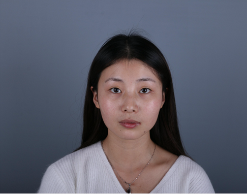 桂林新華醫(yī)療美容醫(yī)生李新華做雙眼皮手術(shù)怎么樣？李新華雙眼皮手術(shù)案例