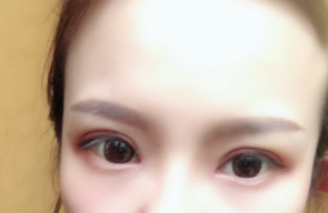 長春麥西美嘉整形醫(yī)生王圣博做雙眼皮手術(shù)效果怎么樣？附雙眼皮案例