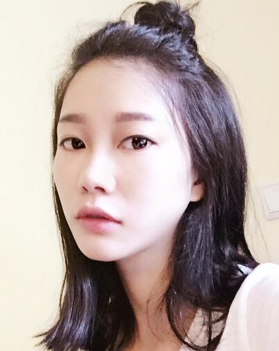 西安陽光整形醫(yī)院邵萍醫(yī)生做鼻綜合整形怎么樣？附鼻綜合整形案例