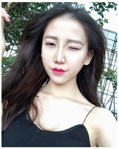 珠海海大整形美容外科黃發(fā)醫(yī)生做面部吸脂怎么樣？附面部吸脂案例