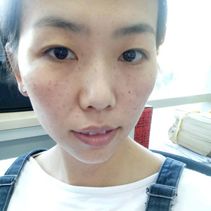 珠海蒂伊醫(yī)療整形醫(yī)生廖俊凱做激光祛斑效果怎么樣？附激光祛斑案例效果圖