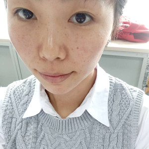 珠海蒂伊醫(yī)療整形醫(yī)生廖俊凱做激光祛斑效果怎么樣？附激光祛斑案例效果圖