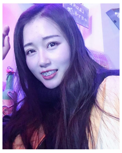 義烏傅氏口腔醫(yī)生朱雨晴做牙齒隱形矯正效果怎么樣？附牙齒隱形矯正案例