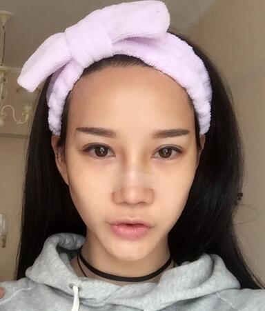 西安陽光整形醫(yī)院邵萍醫(yī)生做鼻綜合整形怎么樣？附鼻綜合整形案例