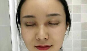 長(zhǎng)沙微笑醫(yī)療整形醫(yī)生段雙軍做切開雙眼皮+開內(nèi)眼角效果怎么樣？附案例