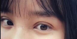 長(zhǎng)沙微笑醫(yī)療整形醫(yī)生段雙軍做切開雙眼皮+開內(nèi)眼角效果怎么樣？附案例