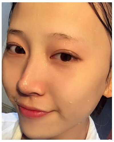 珠海海大整形美容外科黃發(fā)醫(yī)生做面部吸脂怎么樣？附面部吸脂案例