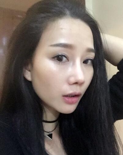 西安陽光整形醫(yī)院邵萍醫(yī)生做鼻綜合整形怎么樣？附鼻綜合整形案例