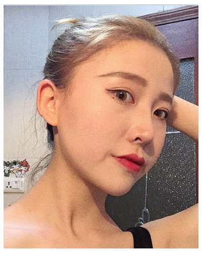 珠海海大整形美容外科黃發(fā)醫(yī)生做面部吸脂怎么樣？附面部吸脂案例