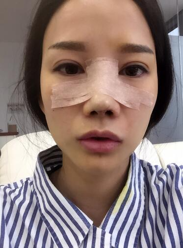 西安陽光整形醫(yī)院邵萍醫(yī)生做鼻綜合整形怎么樣？附鼻綜合整形案例