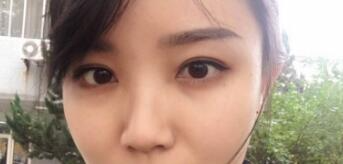 長沙微笑醫(yī)療整形醫(yī)生段雙軍做切開雙眼皮+開內(nèi)眼角效果怎么樣？附案例