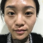 石家莊雅芳亞整形醫(yī)生王文明做雙眼皮+開眼角+鼻綜合整形案例效果對比圖 石家莊雅芳亞整形醫(yī)生王文明做雙眼皮+開眼角+鼻綜合整形案例效果對比圖