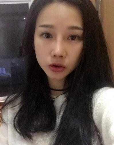 西安陽光整形醫(yī)院邵萍醫(yī)生做鼻綜合整形怎么樣？附鼻綜合整形案例