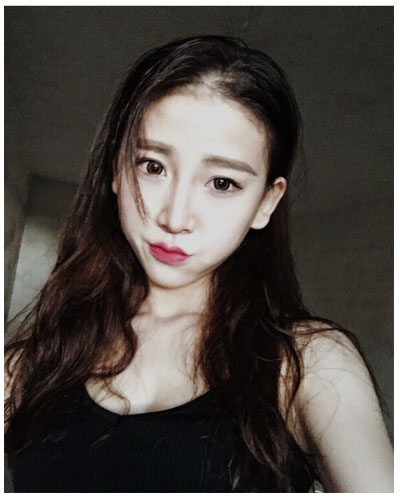 珠海海大整形美容外科黃發(fā)醫(yī)生做面部吸脂怎么樣？附面部吸脂案例