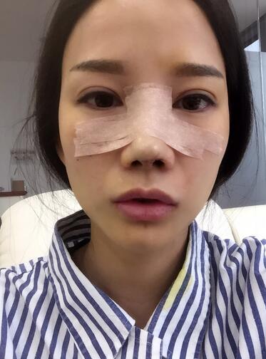西安陽光整形醫(yī)院邵萍醫(yī)生做鼻綜合整形怎么樣？附鼻綜合整形案例