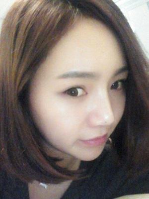 長春中妍整形醫(yī)院吳學(xué)軍醫(yī)生做玻尿酸墊下巴+玻尿酸豐太陽穴案例效果對比圖