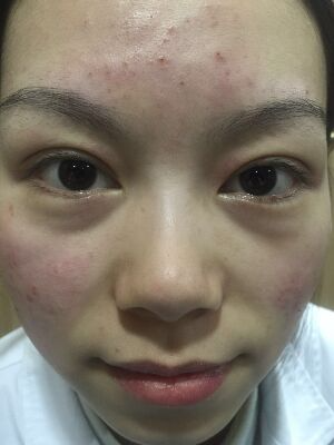 西安壹加壹整形醫(yī)院劉晨醫(yī)生做點陣激光祛痘效果怎么樣？附點陣激光祛痘效果圖