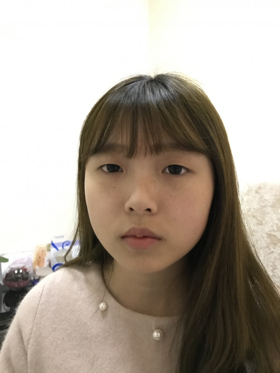 西安米蘭柏羽整形醫(yī)院李旭平做雙眼皮+開眼角技術怎么樣？附醫(yī)院案例