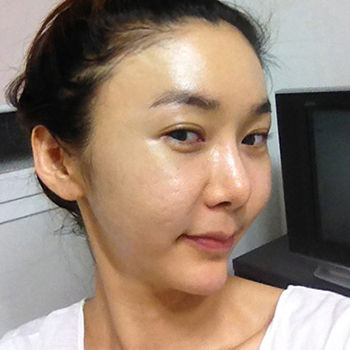 周口華美整形醫(yī)院翟紅光醫(yī)生做面部除皺效果怎么樣？附案例效果對比圖