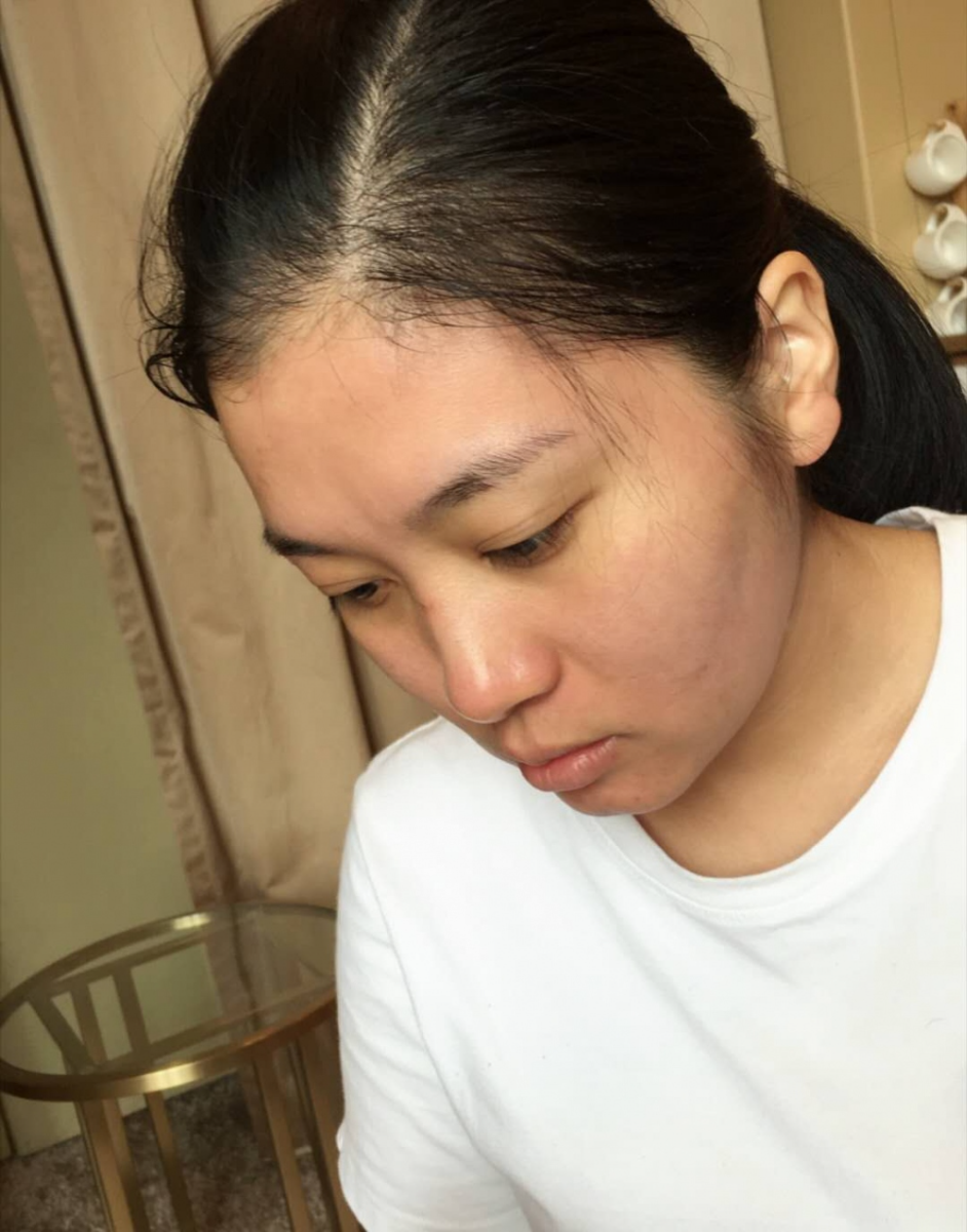 哈爾濱禾力康整形醫(yī)院劉亞春醫(yī)生做點(diǎn)陣激光去痘印效果怎么樣？附案例