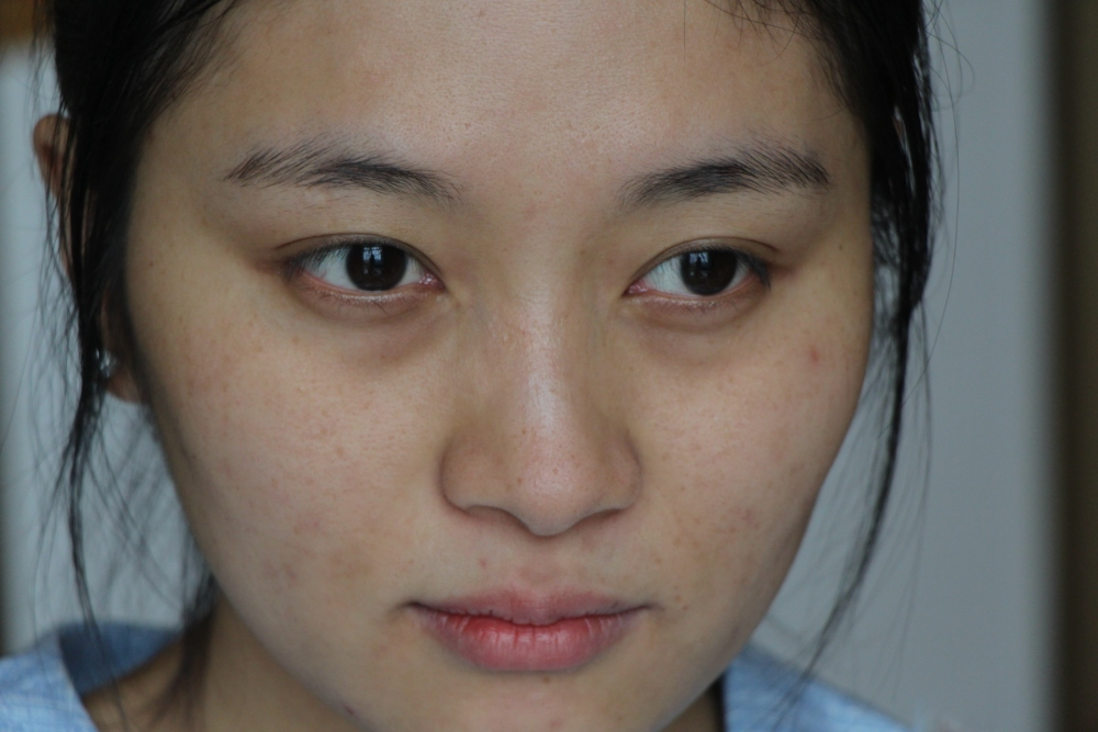 哈爾濱禾力康整形醫(yī)院劉亞春醫(yī)生做點(diǎn)陣激光去痘印效果怎么樣？附案例