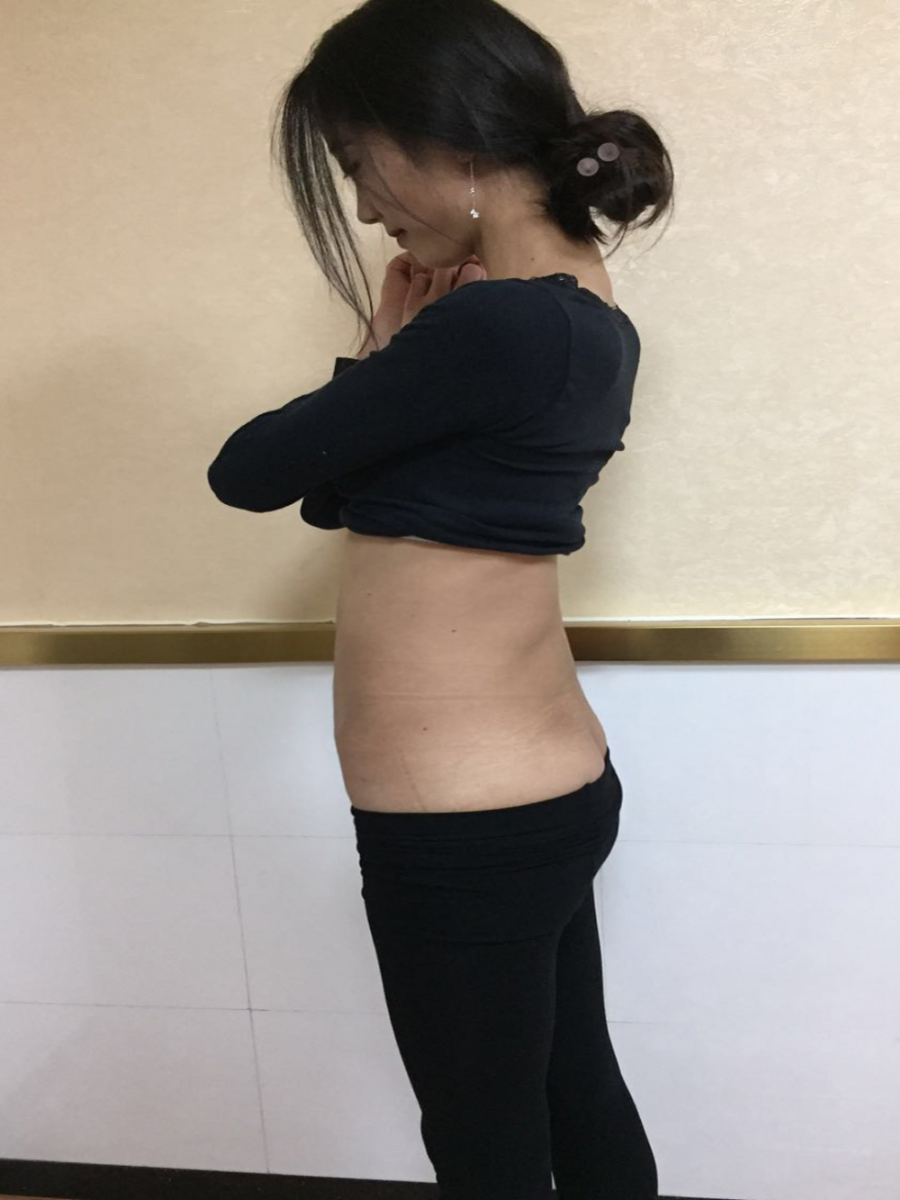 北京東方瑞麗整形醫(yī)生夏兆驥做腰腹吸脂效果怎么樣？附腰腹吸脂案例效果對(duì)比圖