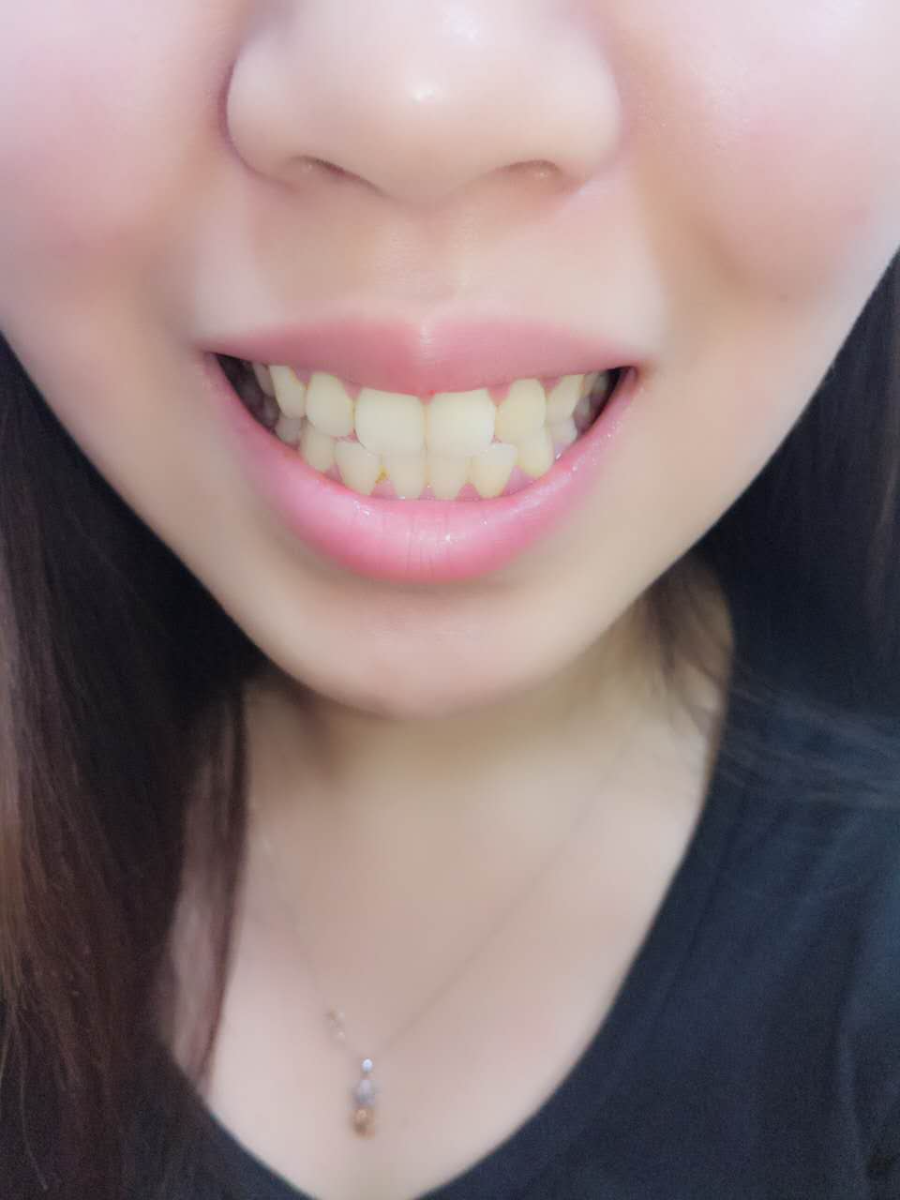 杭州國雅口腔醫(yī)院張虹醫(yī)生做冷光美白效果怎么樣？附冷光美白案例效果對(duì)比圖