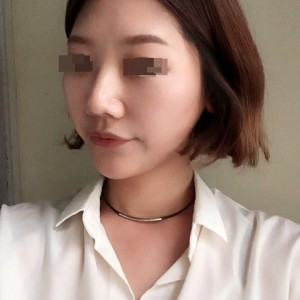 太原麗都整形醫(yī)院劉晉艷醫(yī)生做光纖溶脂瘦臉怎么樣？附案例效果對比圖