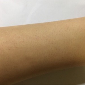 鄭州屈小麗醫(yī)療整形醫(yī)院醫(yī)生劉丹做手臂脫毛怎么樣？附手臂脫毛案例