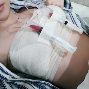 廣州廣大整形美容醫(yī)院醫(yī)生查旭山做假體隆胸怎么樣？附案例