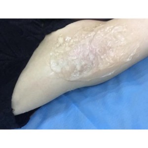 廈門張銘整醫(yī)療整形醫(yī)生張小玲做激光脫腋毛怎么樣？附激光脫腋毛效果對比圖