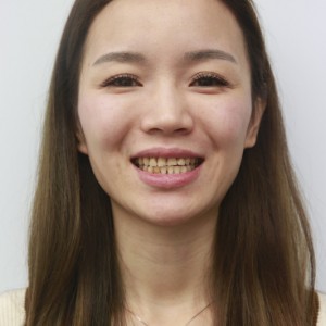 安慶渡江口腔醫(yī)院張良斌醫(yī)生牙齒貼面怎么樣？附牙齒貼面效果圖