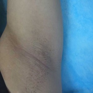 廈門張銘整醫(yī)療整形醫(yī)生張小玲做激光脫腋毛怎么樣？附激光脫腋毛效果對比圖