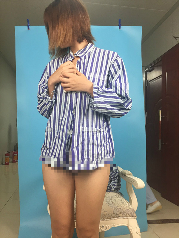 北京蒂凡妮整形靳玉彪醫(yī)生做大腿吸脂怎么樣？附大腿吸脂案例效果對(duì)比圖