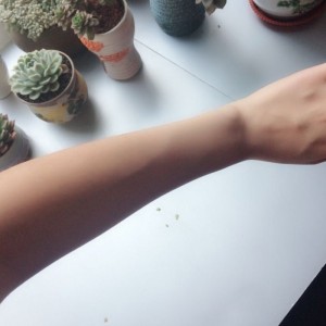 鄭州屈小麗醫(yī)療整形醫(yī)院醫(yī)生劉丹做手臂脫毛怎么樣？附手臂脫毛案例