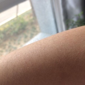 鄭州屈小麗醫(yī)療整形醫(yī)院醫(yī)生劉丹做手臂脫毛怎么樣？附手臂脫毛案例