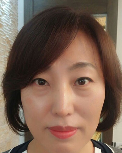 北京四季美學(xué)炫美整形醫(yī)生高玲做埋線祛眼袋怎么樣？附案例效果對比圖