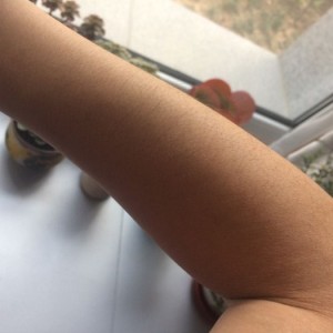 鄭州屈小麗醫(yī)療整形醫(yī)院醫(yī)生劉丹做手臂脫毛怎么樣？附手臂脫毛案例